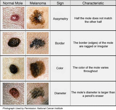 melanoma skin cancer. Melanomas vary greatly in