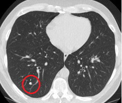 lung ct cancer early scans scan tumor lower study smokers does deaths detect former program current cornell according weill shows