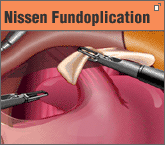 Nissen Fundoplication