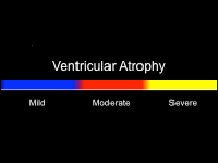Ventricular Atrophy