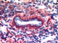 image of a lymphoma tumor