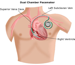 Weill Cornell Cardiology - Pacemakers, Implantable Cardioverter ...