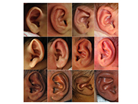 Newborn Butterfly Project Non-Surgically Corrects Infant Ear ...